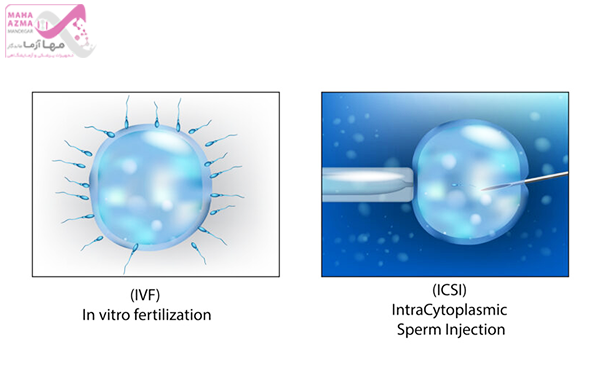 تفاوت ای وی اف (IVF) و میکرواینجکشن (ICSI ) در چیست ؟